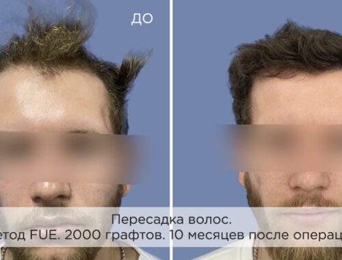 Что такое пересадка волос?
