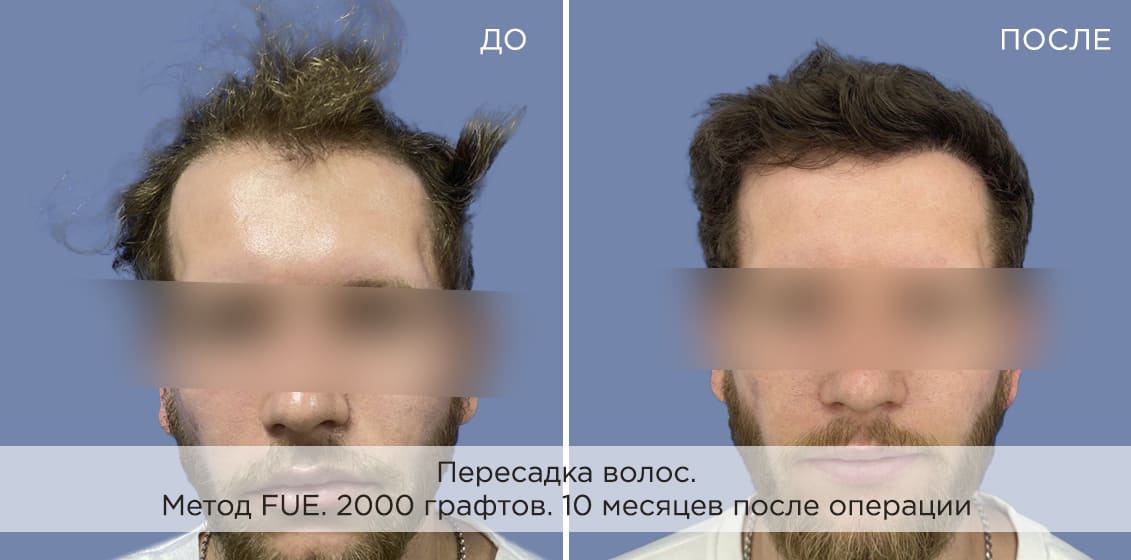 Что такое пересадка волос?