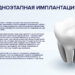 Преимущества имплантации зубов в клинике СВ-ДЕНТ+
