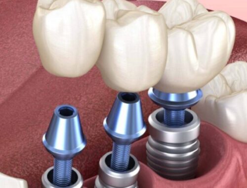 Зубные имплантаты в Ессентуках: восстановление улыбки на долгие годы Зубные имплантаты в Ессентуках: восстановление улыбки на долгие годы