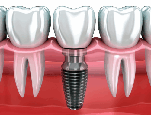 Цены на имплантацию зубов под ключ